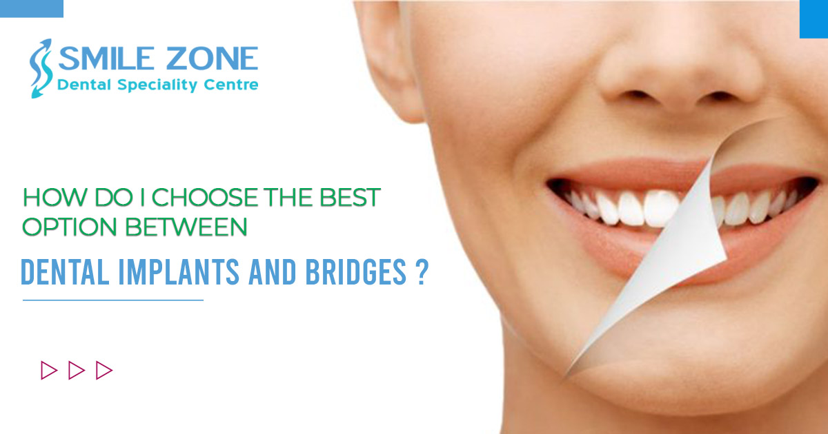 Which option is considered beneficial between dental implants and bridges?